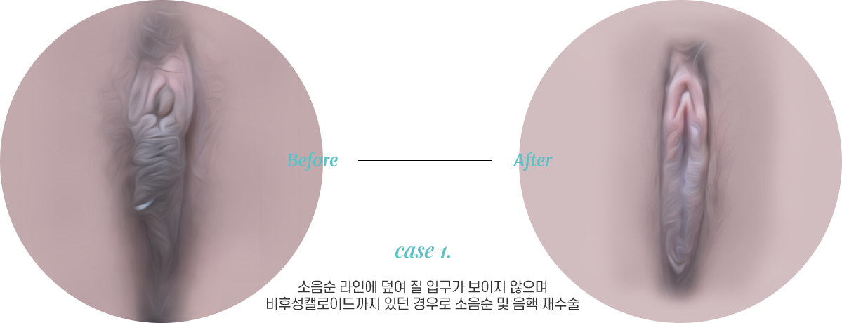 전후사진1